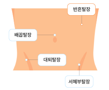 성인탈장 발생 위치